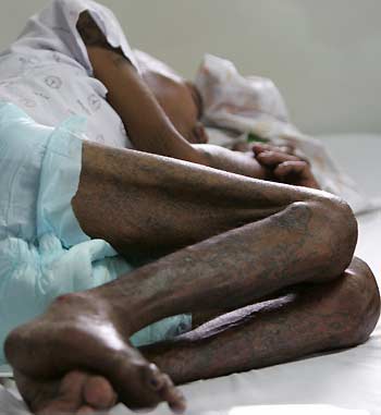 An AIDS patient lies in his bed at a hospital inside the Buddhist Prabat Namphu Temple in central Lopburi province, 150 km (93 miles) northeast of Bangkok, November 28, 2005. According to Thailand's Health Ministry, there have been 1.1 million AIDS patients in the country in the past 21 years, about half of whom are still alive. The government estimates there are 18,000 new infected patients this year, mostly aged between 20 and 39. World Aids Day is commemorated around the globe on December 1.